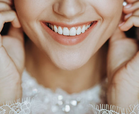 teeth-whitening-for-wedding.jpg