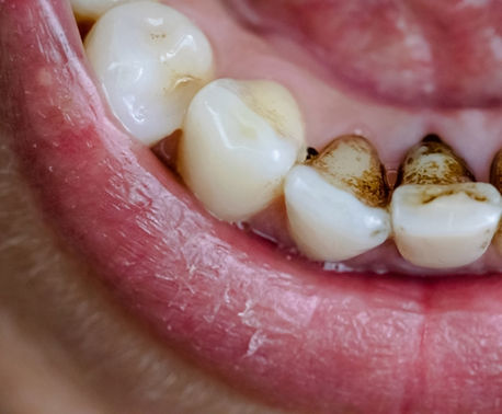 how-to-remove-nicotine-stains-from-teeth.jpg