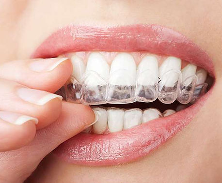invisalign-1.jpg