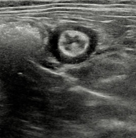 Abdo-ileo-cieco-colic junction
