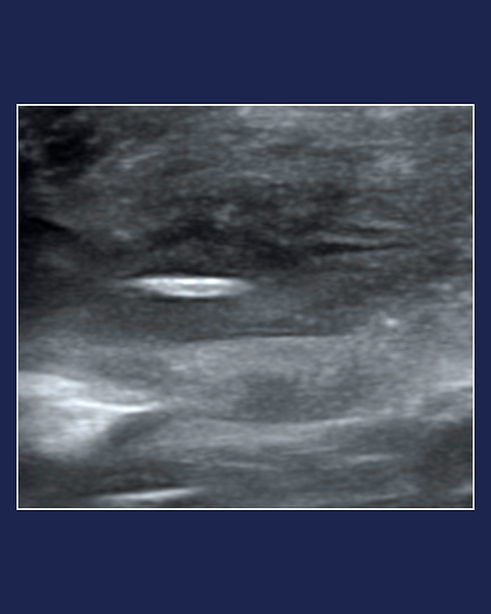 Ultrasound image ultrasound guided procedure