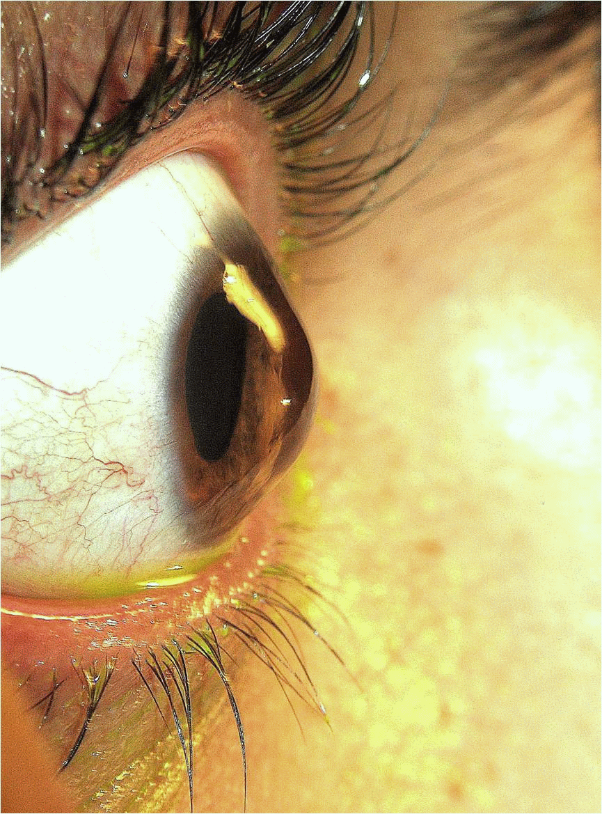 Ceratocone