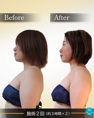 筋膜リリース整体西調布の施術による女性の横姿・首肩ラインの整調変化