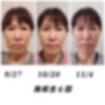 小顔矯正