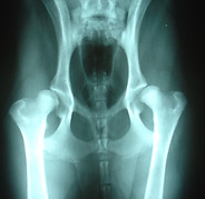 Bilateral_hip_dysplasia.jpg