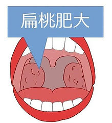 扁桃肥大により、空気の通り道が狭くなる