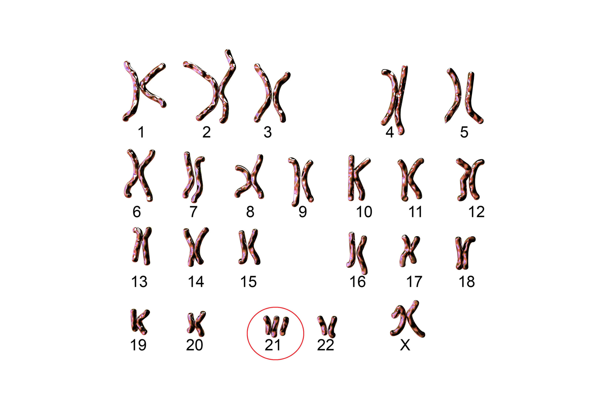 Trisomie 21