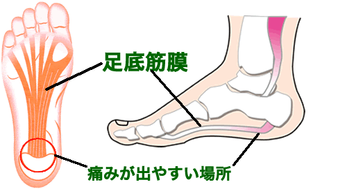 足底筋膜炎