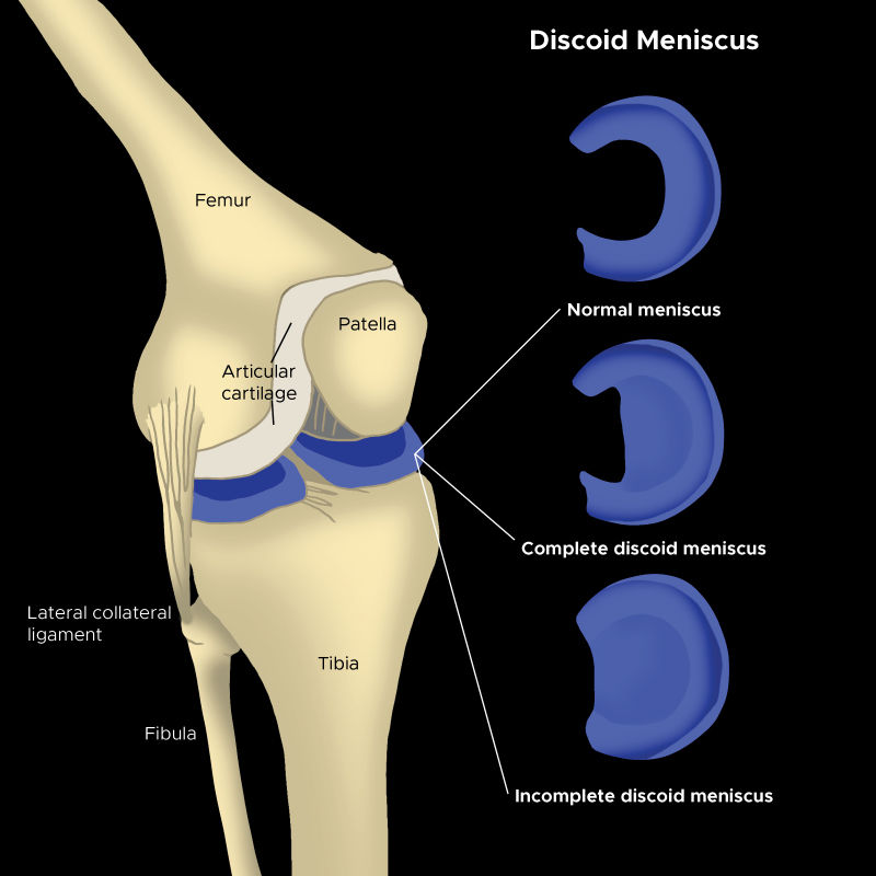 There’s a Disc in My Knee? Understanding Discoid Meniscus