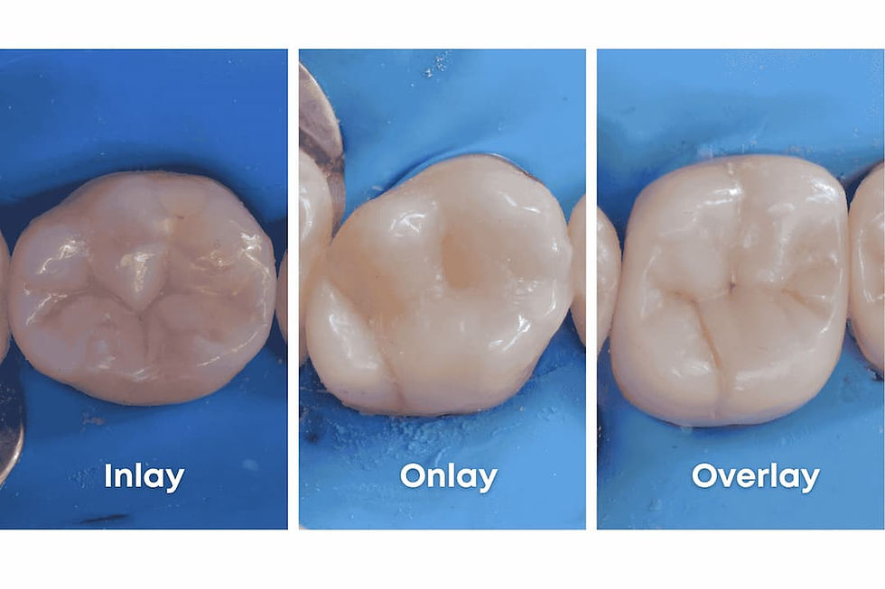 Comparación clínica entre tipos de incrustación dental: Inlay, Onlay y Overlay. Restauraciones adhesivas realizadas en Artizahn, Surco.