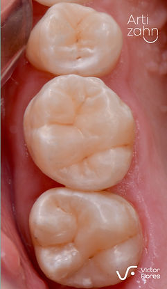 Curación dental resultado final, luego del pulido y ajuste oclusal en Artizahn,Surco.