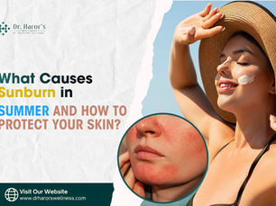 What Causes Sunburn in Summer and How to Protect Your Skin?