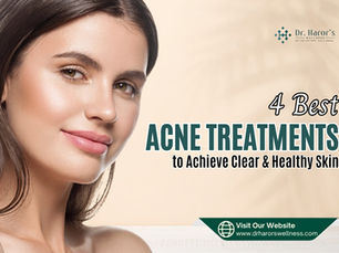 4 Best ACNE Treatments to Achieve Clear & Healthy Skin 