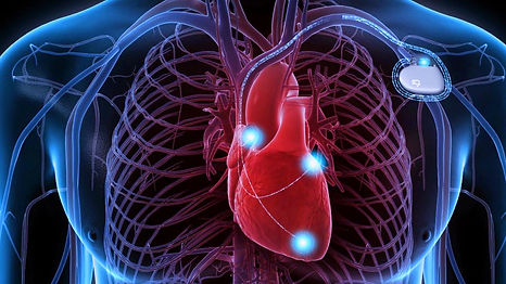 cardioverterdefribrillator_edited.jpg