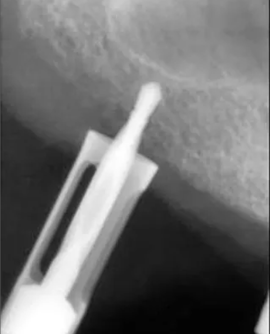 Auto chip maker - autologous bone graft for crestal Sinus Lift content media