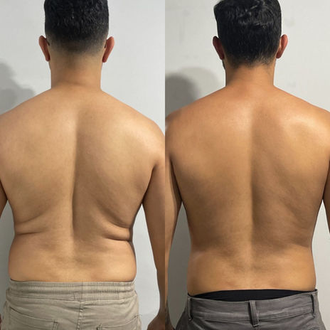 O resultado de antes e depois da gordura nos flancos no Estética Para Homens
