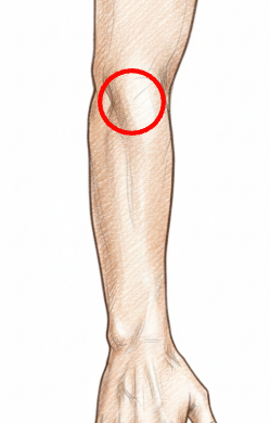 外側上顆炎(テニス肘)について