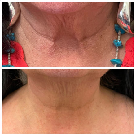 clearlift laser spanish fork utah