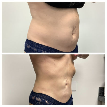 liposuction spanish fork