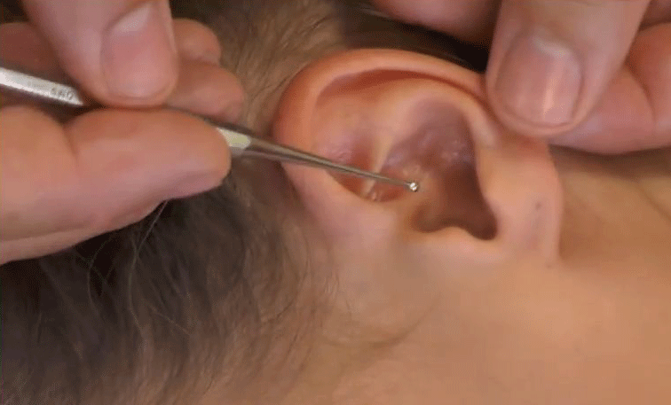 réflexologie auriculaire