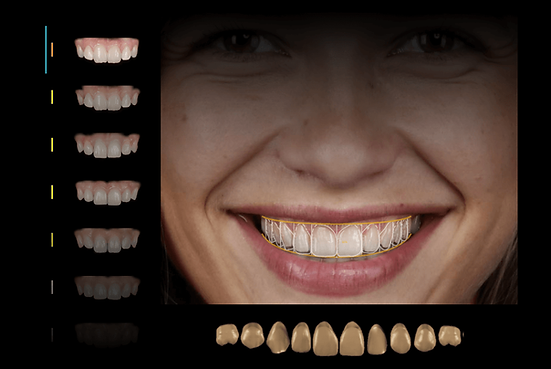 Prévia do seu sorriso com implante dentário com tecnologia no brooklin