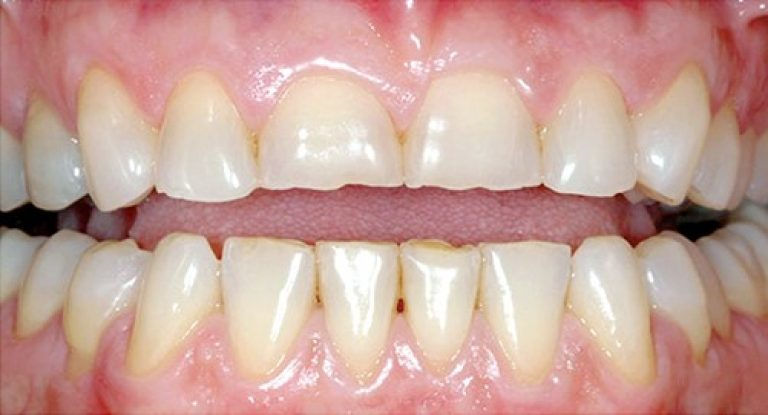 What Happens to Your Teeth After Years of Grinding