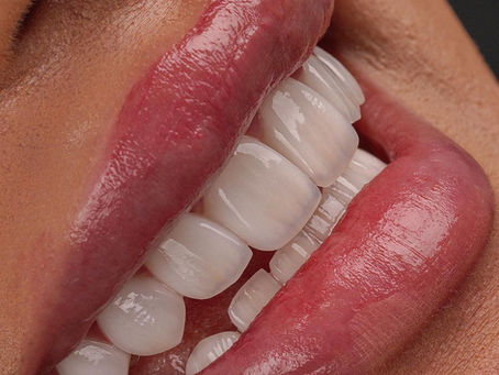 See How Veneers Can Transform Your Smile