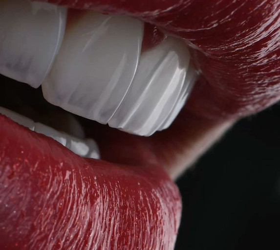 sorriso perfto usando lente de contato dental