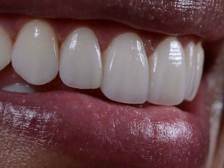 Como Cuidar das Lentes de Contato Dental