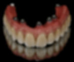 implante dentário