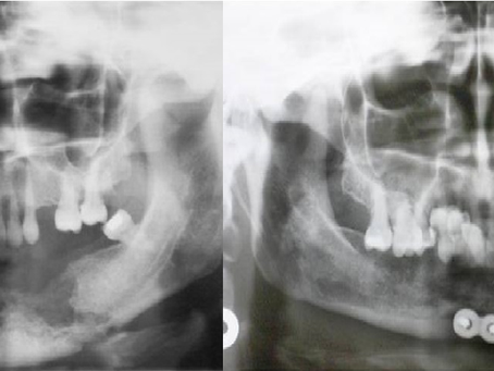 Osteorradionecrose
