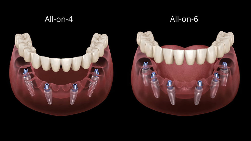 All‑on‑4 vs. All‑on‑6 Dental Implants in Brazil
