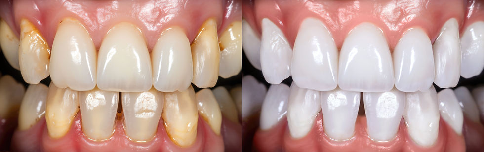 Alimentos que Mancham os Dentes Após o Clareamento