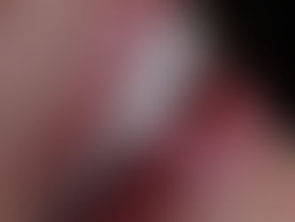 Exemplo de sorriso com facetas de resina no Brooklin SP. 