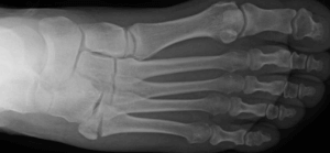 A tuberosity avulsion fracture of the 5th metatarsal can result in poor healing because the tendon continues to pull the fragment open.