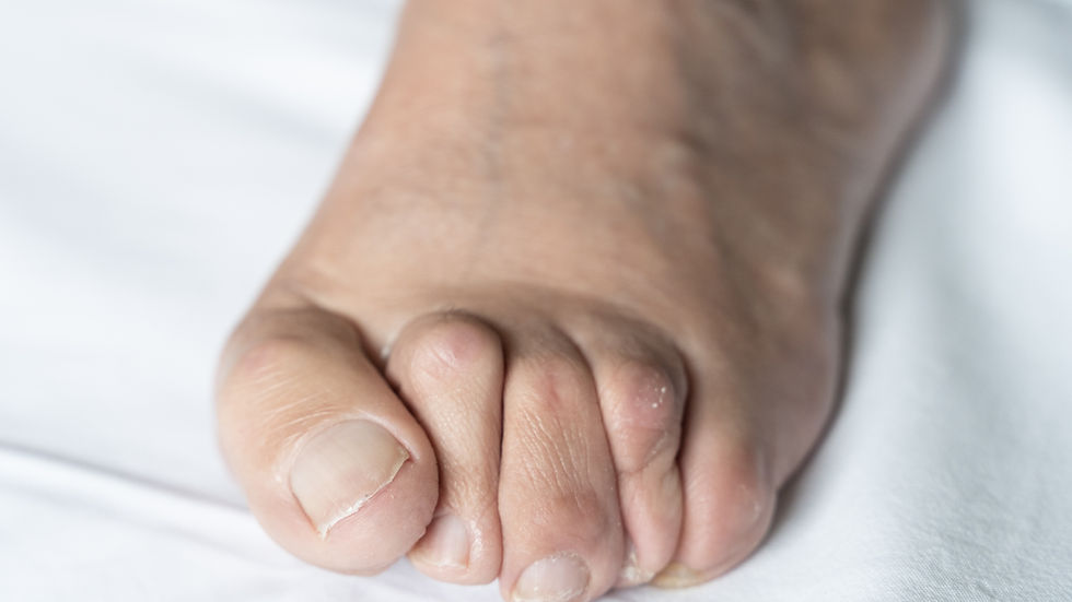 Digital foot deformity.