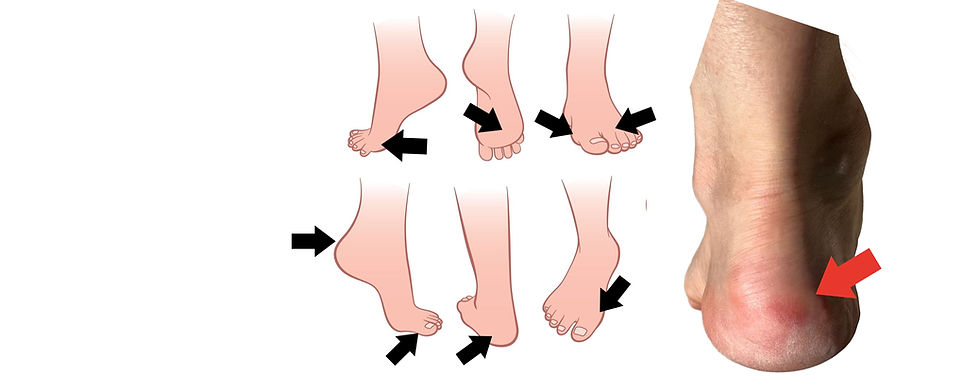 Blisters can affect any part of the foot exposed to pressure.