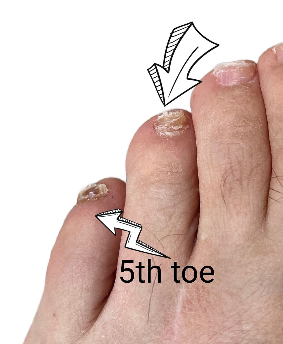 Fig. 3. Long-term effects of nail damage five years after the 4th toe was damaged by shoe pistoning. The 5th toe was destroyed as a child and thickened over the decades. Male aged =69.