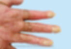Deformidades de las uñas post quemaduras