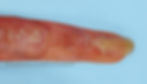 Deformidades de las uñas post quemaduras