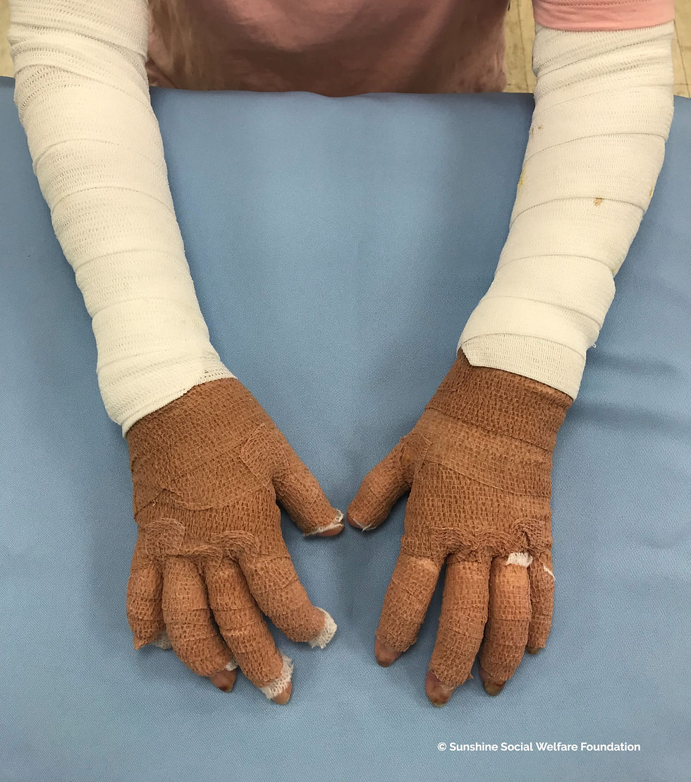 Uso de vendaje Coban sobre mano con cicatrices de quemaduars