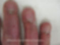 Deformidades de las uñas post quemaduras