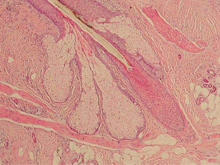 Hair follicles harbour sentinel cells for immune surveillance