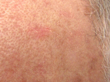 Use of ingenol mebutate may increase risk of skin cancer