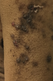 prurigo nodularis 03