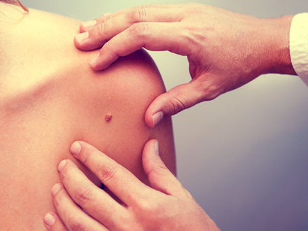 Skin cancer: Diagnosis using naked eye may not be accurate