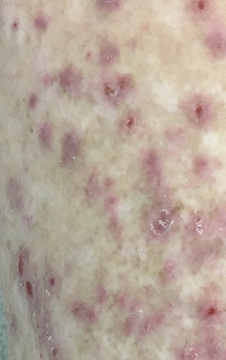 prurigo nodularis 02
