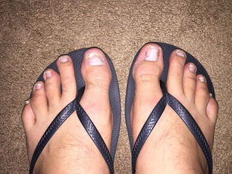Nail psoriasis: N-NAIL shows higher diagnostic accuracy in study