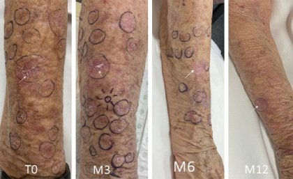 Cancer immunotherapy also reduces actinic keratoses