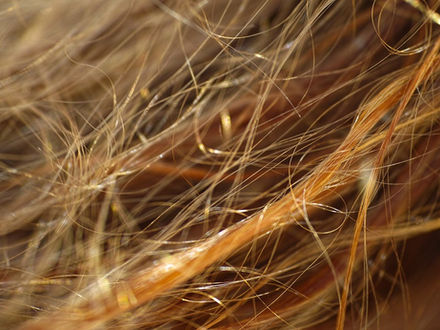 Some skin cancers may start in hair follicles